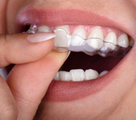 What+to+know+about+clear+aligners-+aligners+pros+and+cons-+what+are+clear+aligners+and+teeth+aligner