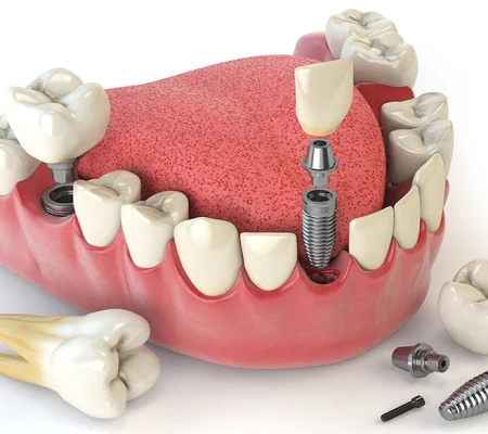 b2ap3_large_dental-implants
