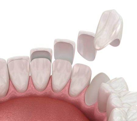 Dental veneer placement over frontal teeth. 3D illustration