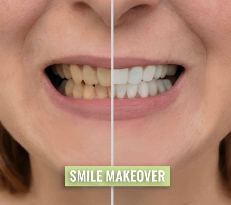 smile-makeover-smile-design-london-2